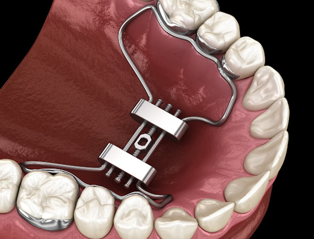Adjusting Palatal Expander | At Home Adjustment | Get It Straight